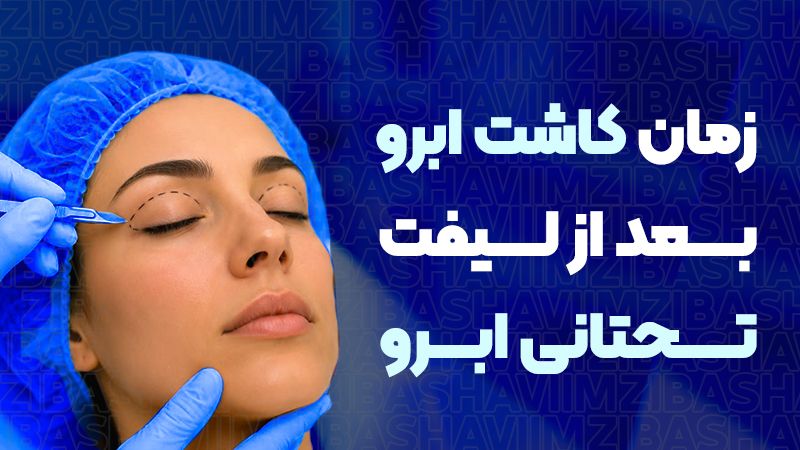 چه زمانی بعد از لیفت تحتانی ابرو میتوان ابرو کاشت؟
